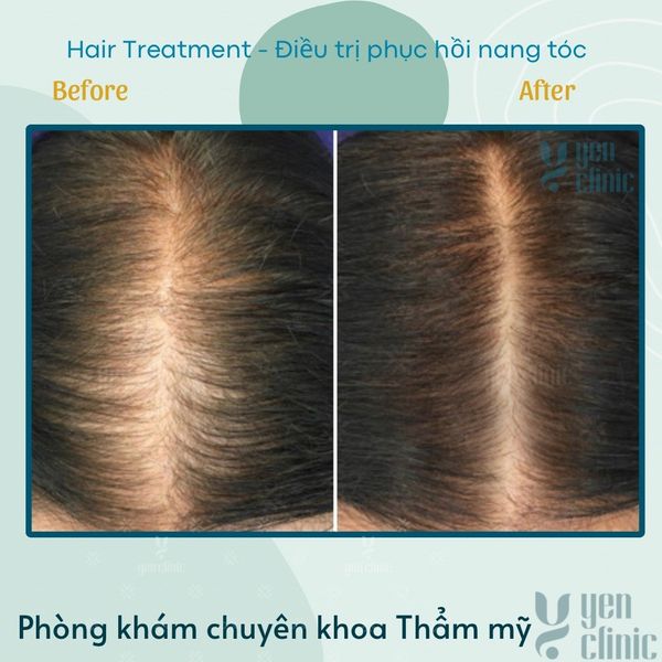 HAIR FOLLICLE RESTORATION TREATMENT - ĐIỀU TRỊ PHỤC HỒI NANG TÓC -  NIỀM HI VỌNG CHO BỆNH NHÂN RỤNG TÓC HÓI ĐẦU