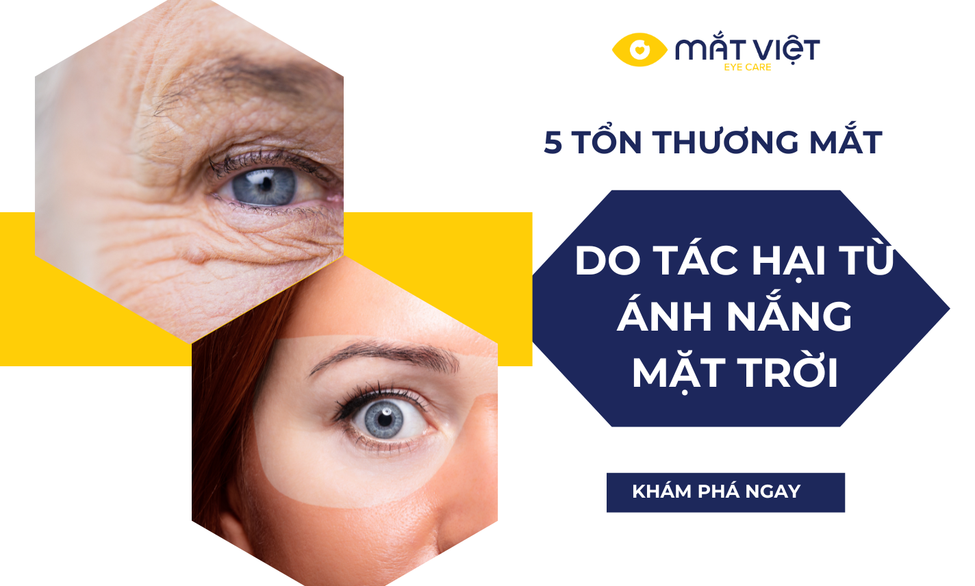 5 bệnh về mắt do tổn thương từ ánh nắng mặt trời