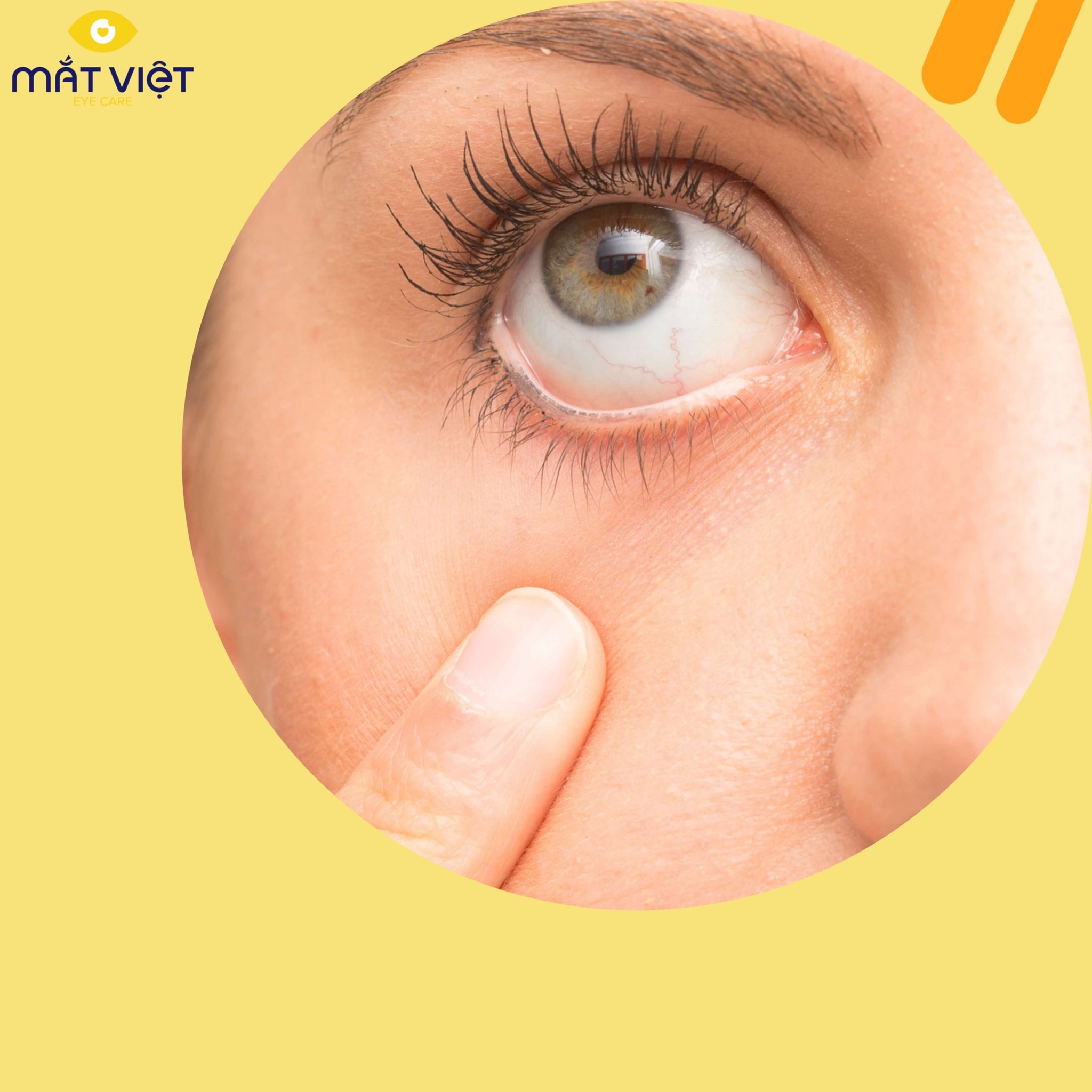 Bệnh khô mắt là gì? Phân biệt khô mắt và dị ứng mắt mùa lạnh