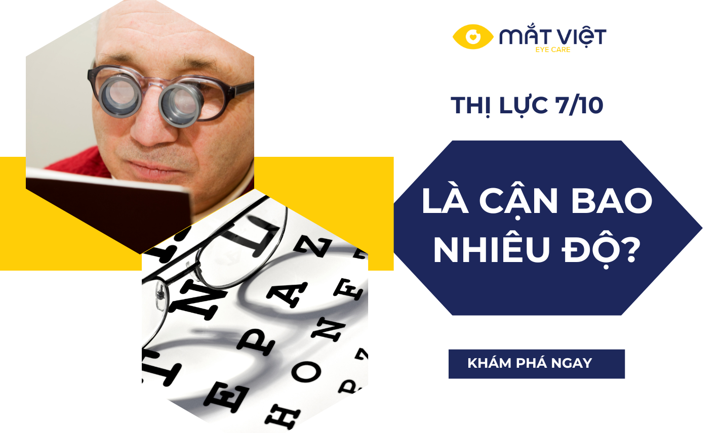 Thị lực 7/10 là cận bao nhiêu độ? Các mức độ thị lực cần lưu ý