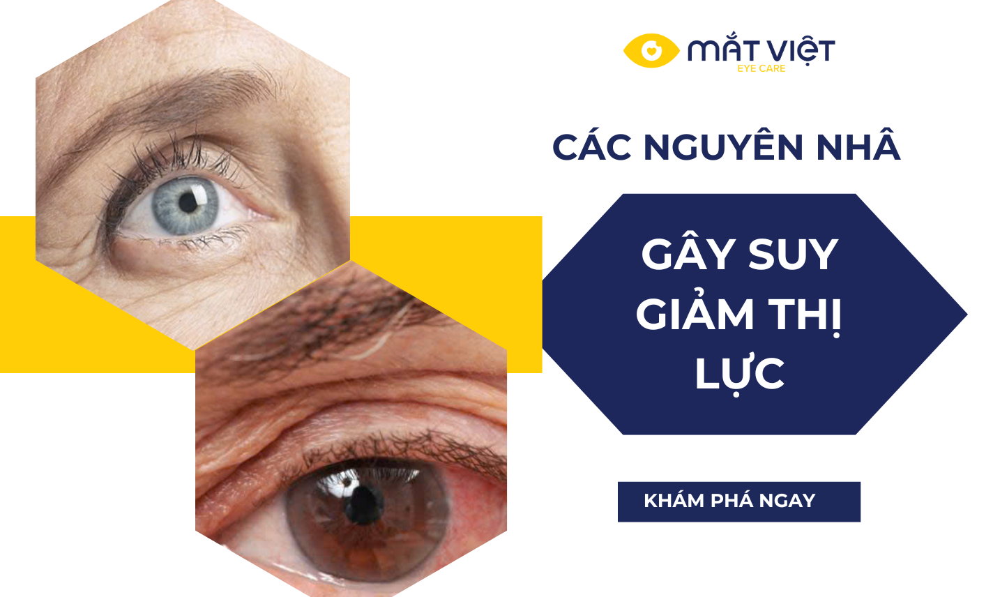 Top 5 nguyên nhân hàng đầu gây suy giảm thị lực