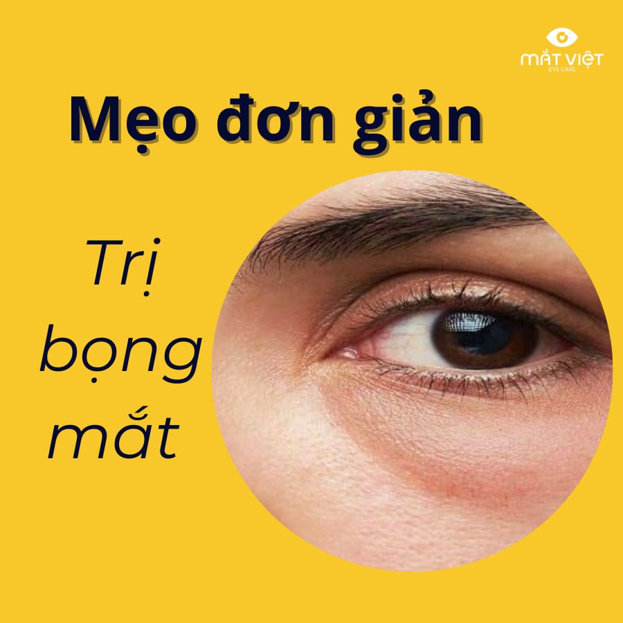 Mẹo đơn giản trị bọng mắt