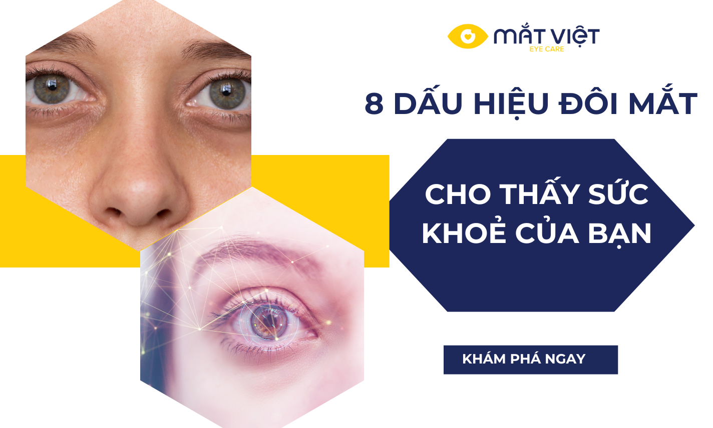 8 dấu hiệu của đôi mắt tiết lộ về sức khoẻ của bạn