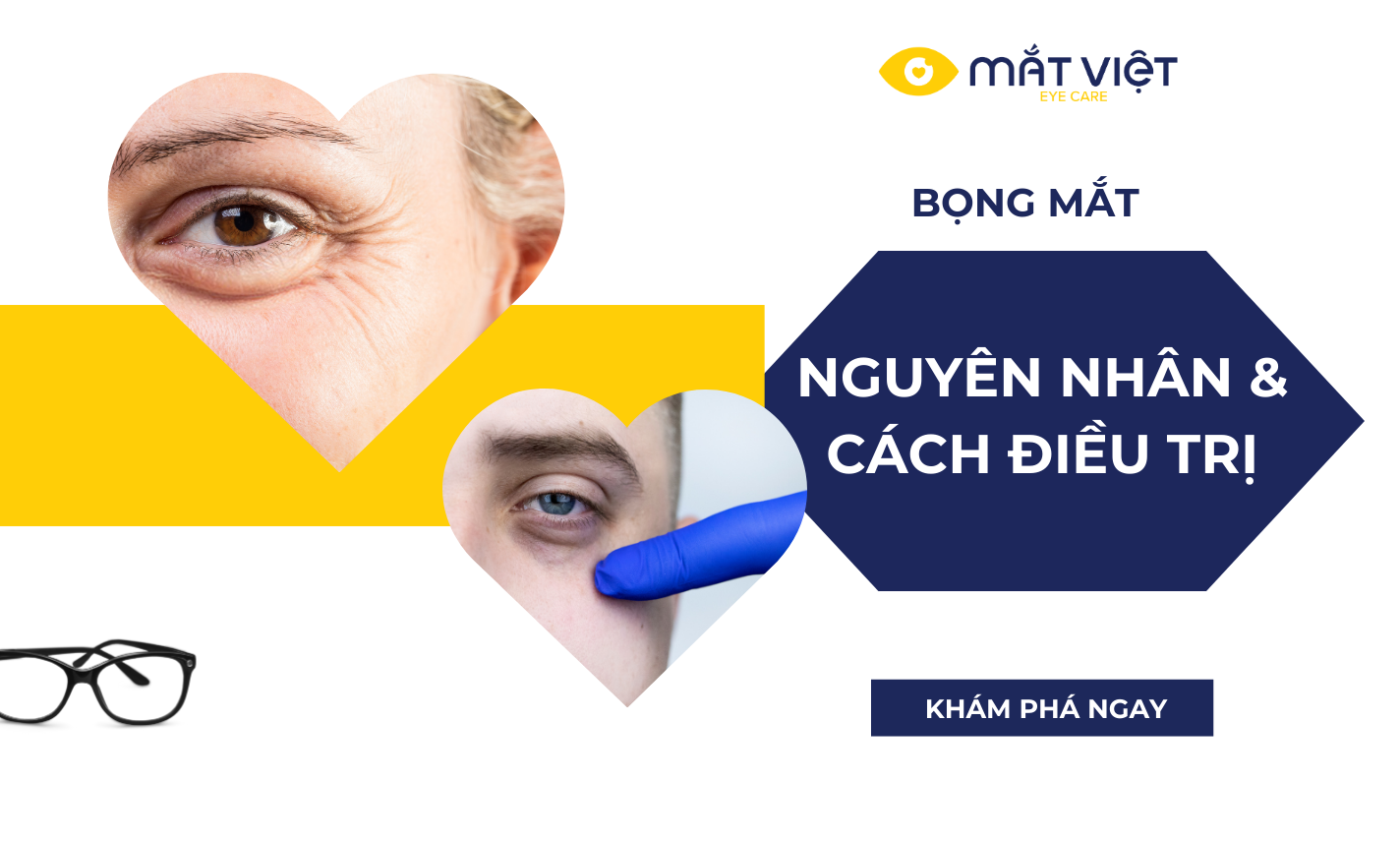 Bọng Mắt – Nguyên Nhân, Cách Điều Trị Và Phòng Ngừa Hiệu Quả