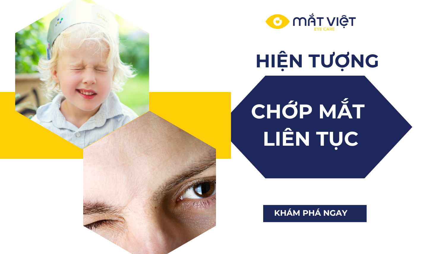 Hiện tượng chớp mắt liên tục có nguy hiểm? Cách khắc phục