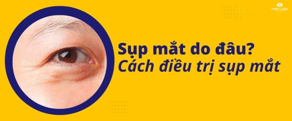 Bị sụp mí mắt do đâu? Cách điều trị sụp mí mắt