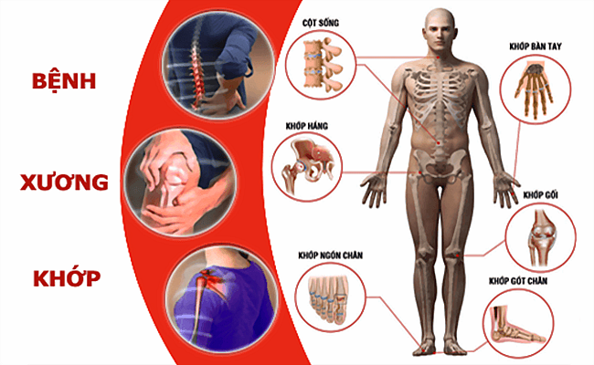 Bệnh xương khớp và cách điều trị bệnh xương khớp hiệu quả