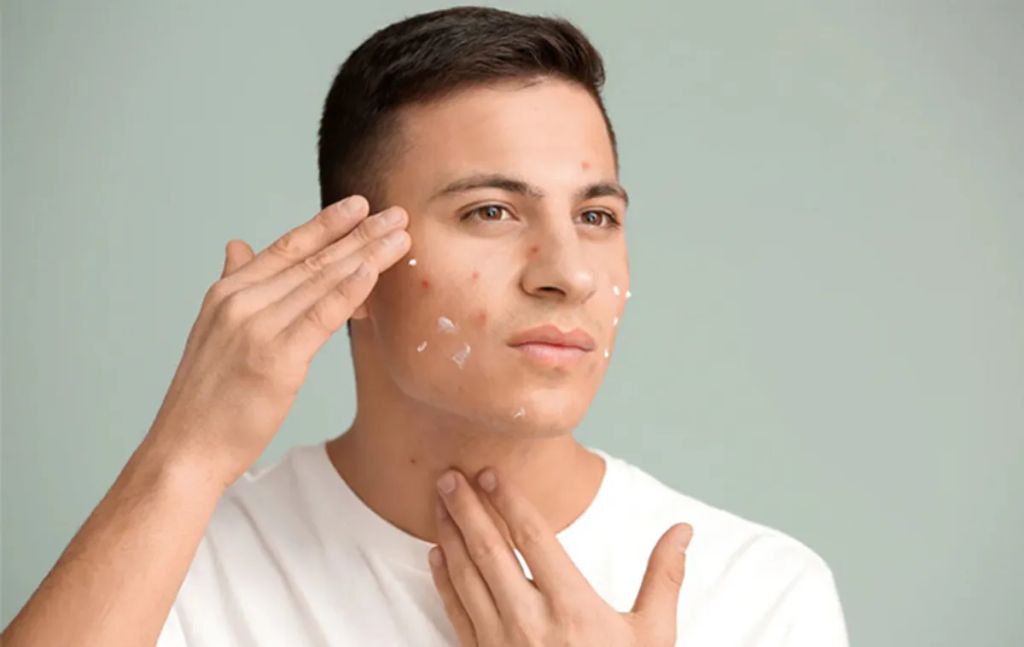 Cách Trị Mụn Nội Tiết Ở Nam Giới