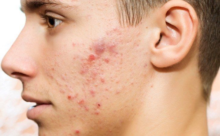 Lý Do Mọc Mụn Da Mặt Ở Nam Giới: Nguyên Nhân Và Cách Phòng Ngừa
