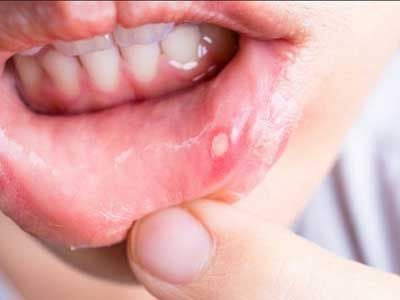 Lý do khiến trẻ bị nhiệt miệng và cách khắc phục