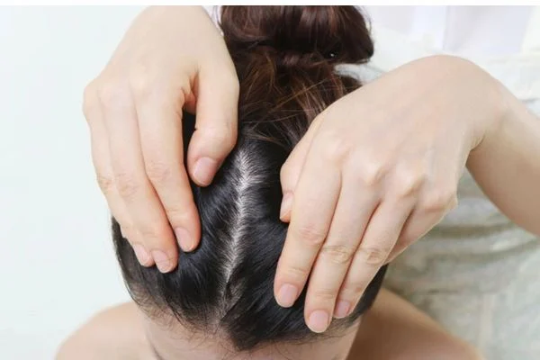 TOP 15+ Cách Làm Sạch Gàu Triệt Để, Nhanh Chóng Tại Nhà