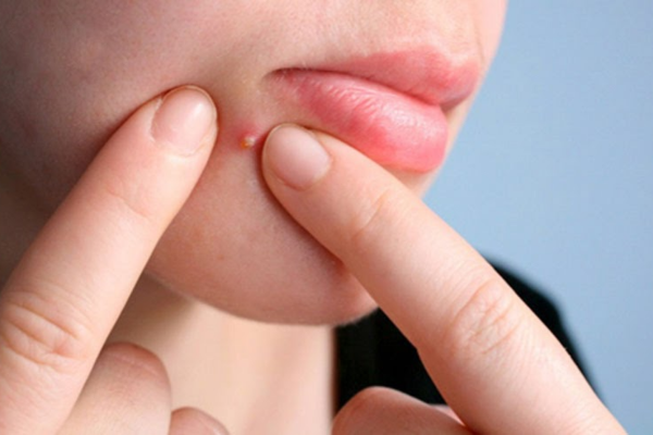 Hướng Dẫn Cách Nặn Mụn Đúng Cách, An Toàn Tại Nhà - L'Occitane Việt Nam