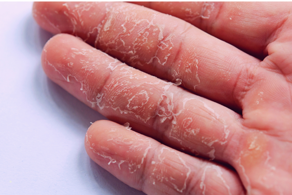 Nguyên nhân & Cách khắc phục da tay bị tróc đơn giản tại nhà