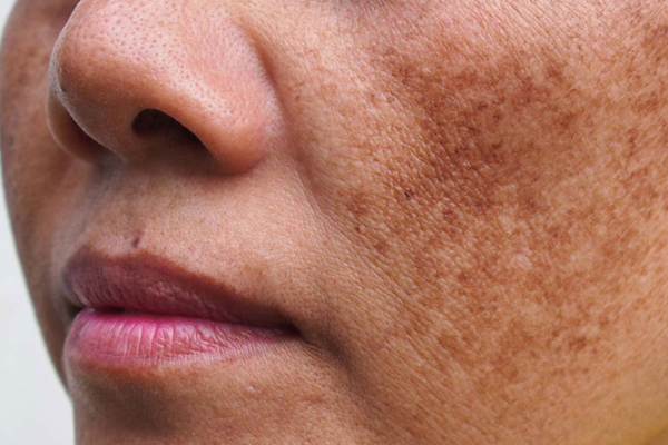 Rối Loạn Sắc Tố Da: Nguyên Nhân & Điều Trị (Chuẩn Y Khoa)