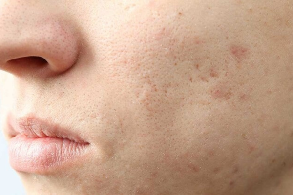 Cách Làm Đầy Sẹo Lõm Cực Hiệu Quả Không Phải Ai Cũng Biết