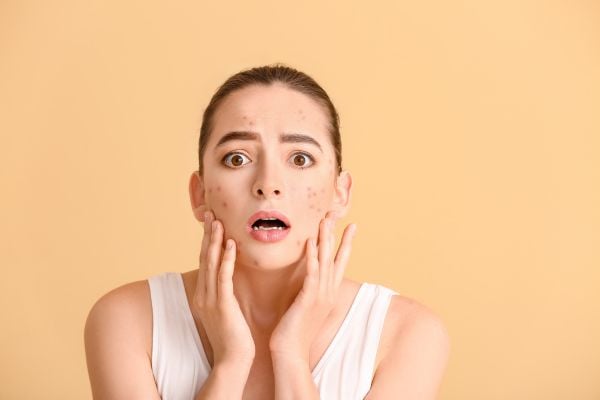 14+ Cách Trị Thâm Mụn Nhanh, Hiệu Quả Nhất Hiện Nay
