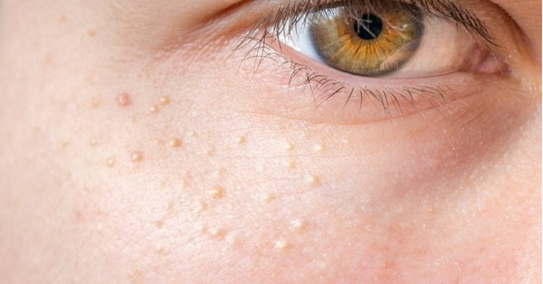 các loại mụn trên mặt