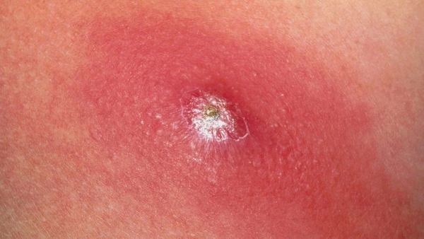 các loại mụn trên mặt