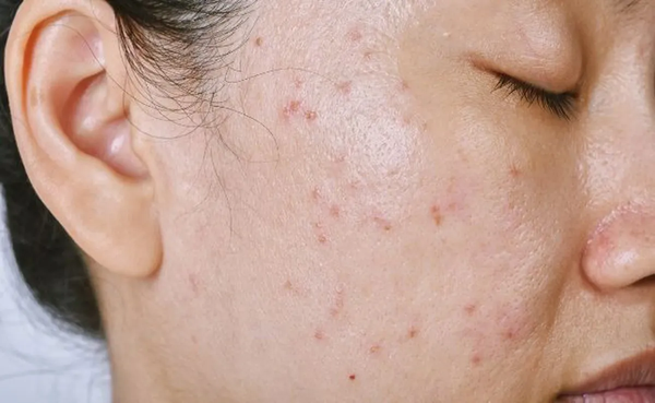 cách nhận biết da mặt