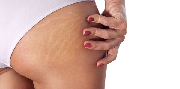 Có rất nhiều nguyên nhân gây rạn da