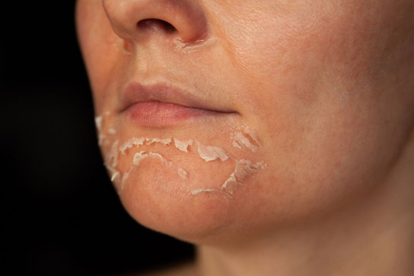 Thay da sinh học là gì