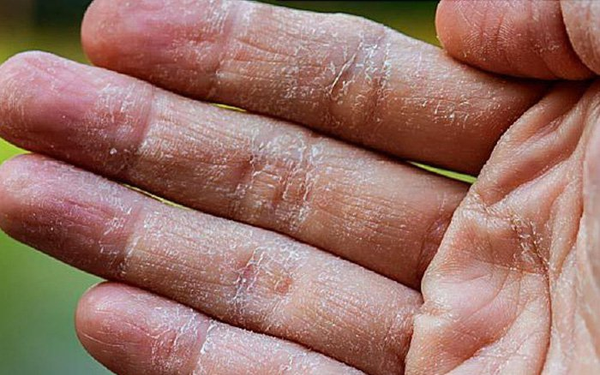 Hand skin is affected by the weather