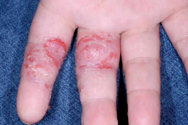 Severe hand inflammation