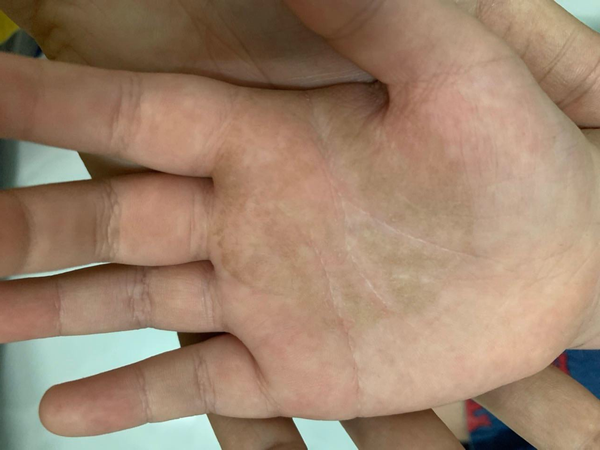 Hand skin infection