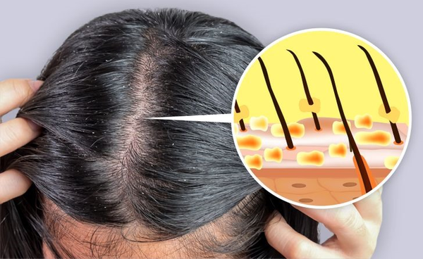 Da đầu bị gàu ngứa gây khó chịu