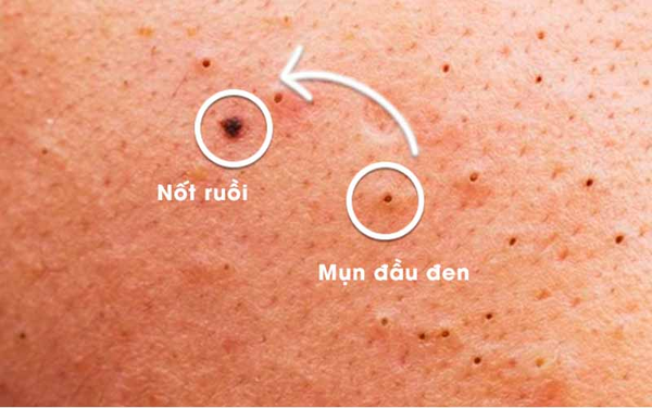 Không nặn mụn có tự hết không