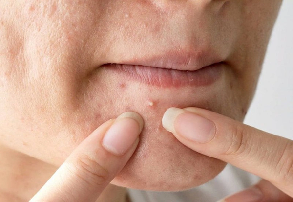 Không nặn mụn có tự hết không