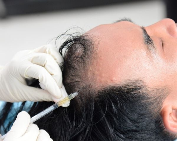 kích thích mọc tóc