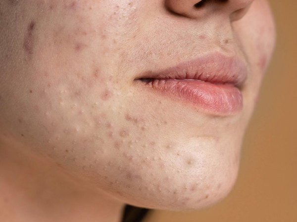 mụn ẩn là mụn gì