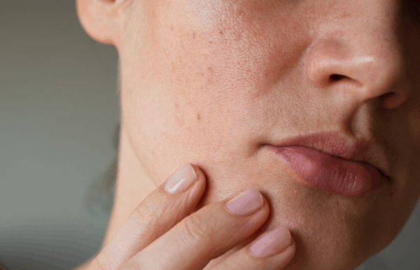 mụn ẩn là mụn gì