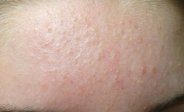 mụn ẩn là mụn gì