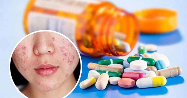 mới nặn mụn xong nên làm gì