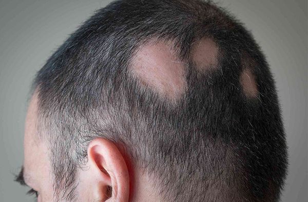 Các đốm hói là dấu hiệu rụng tóc do di truyền