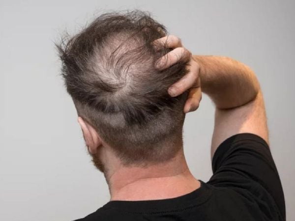 Người già là đối tượng dễ bị rụng tóc