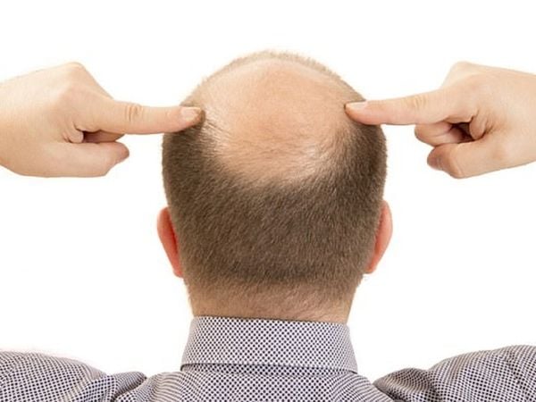 Tác dụng phụ của một số loại thuốc có thể dẫn đến rụng tóc