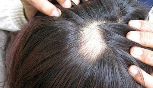 Nấm có thể khiến tóc rụng từng mảng