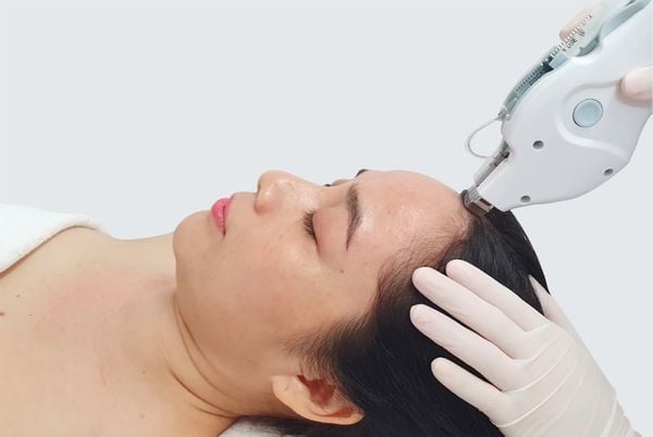 Chữa rụng tóc bằng laser ít gây đau đớn