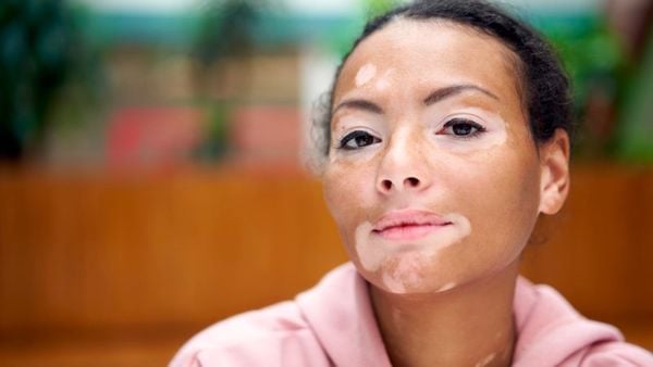 Rối loạn sắc tố da