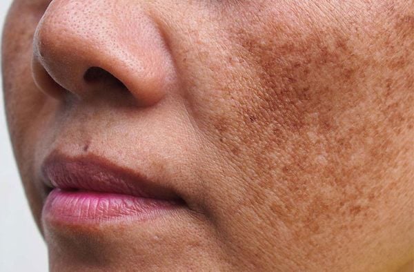 Rối loạn sắc tố da