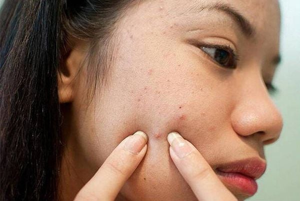 Sẹo lõm