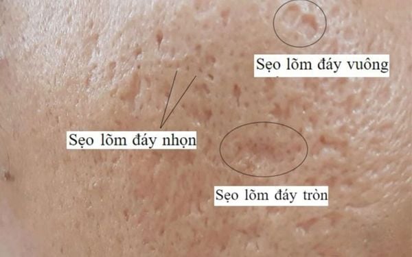 Sẹo lõm