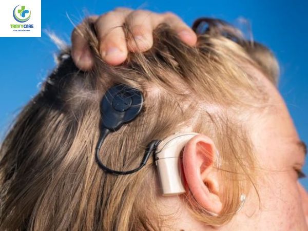 Hình ảnh về cấy điện cực ốc tai