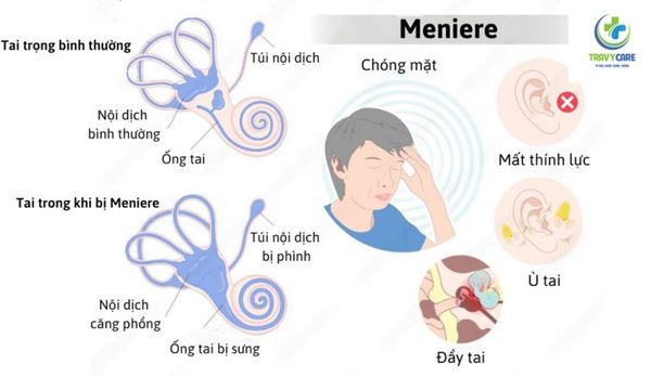 Các triệu chứng thường gặp của bệnh Meniere