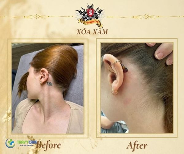 Xóa xăm tại Rio Tattoo Studio