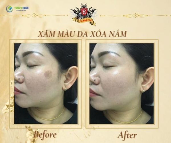 xăm màu da xóa nám tại Rio Tattoo Studio