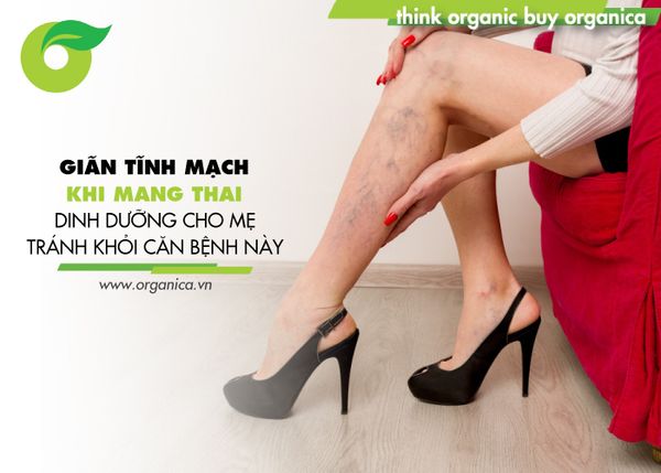 Giãn tĩnh mạch khi mang thai: Dinh dưỡng cho mẹ tránh khỏi căn bệnh này